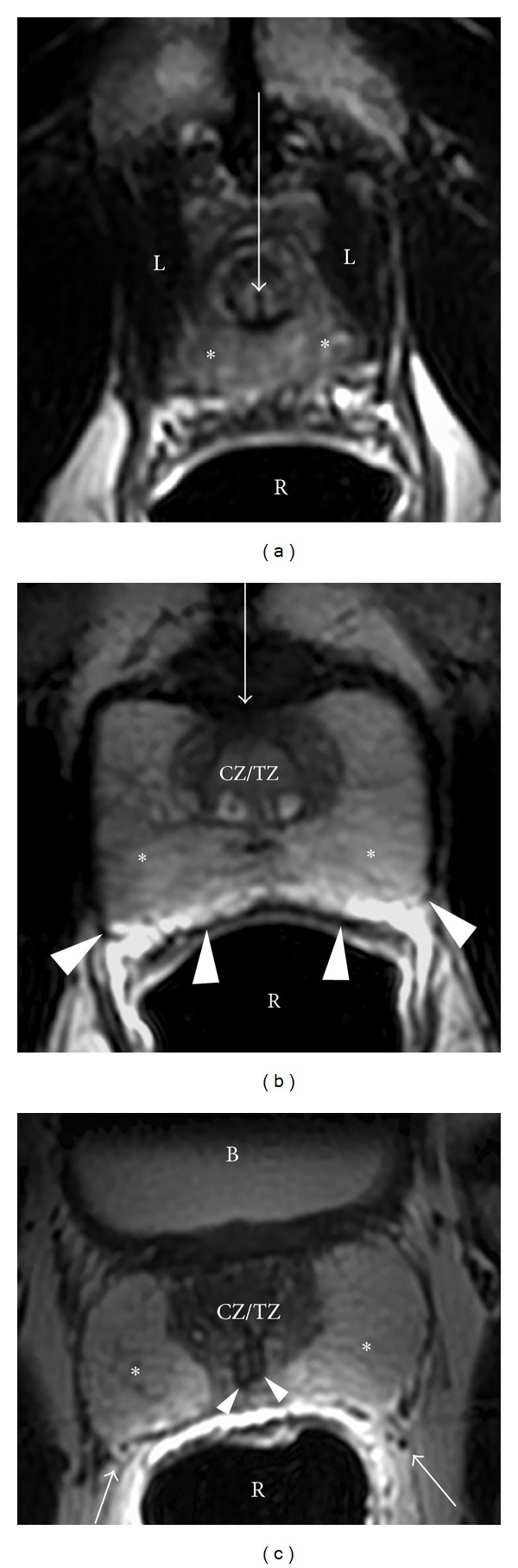 Axial MRI sections of the prostate from apex to base showing zonal anatomy