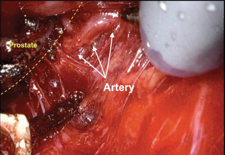 Intraoperative view showing neurovascular bundle dissection during radical prostatectomy