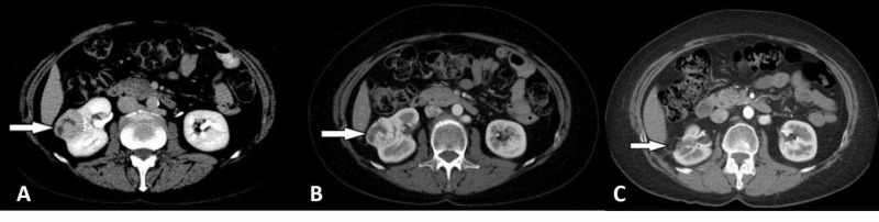 CT scan showing enhancing renal mass consistent with clear cell renal cell carcinoma