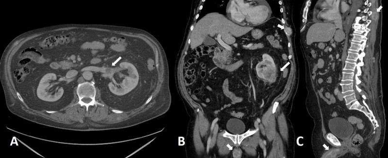 CT scan showing renal cell carcinoma with tumor thrombus extending into the renal vein and IVC