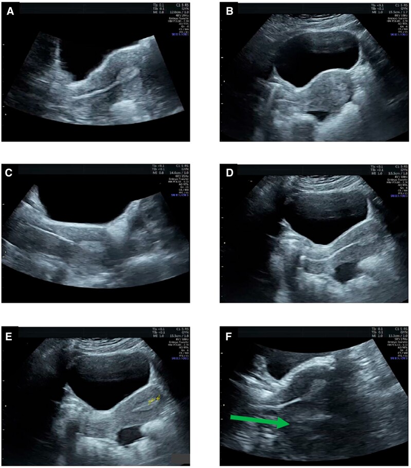Ultrasound images during embryo transfer showing catheter tip position and air bubble visualization in uterine cavity