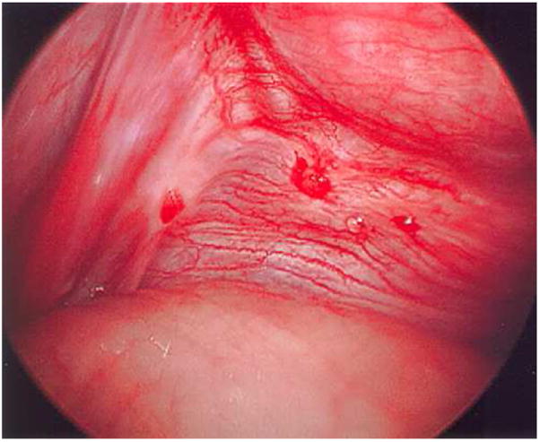 Red vesicular endometriosis lesions with focal hemorrhage and neovascularization on peritoneal surface