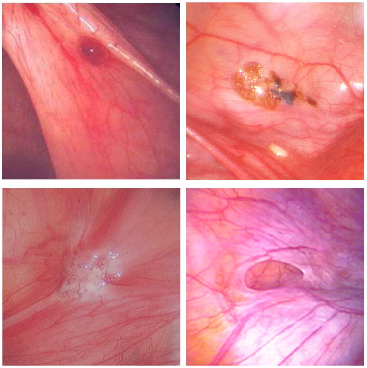 Phenotypic subtypes of peritoneal endometriosis showing red, black, and white lesions at different stages
