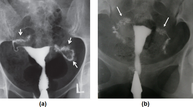 HSG showing salpingitis isthmica nodosa with diverticula projecting from isthmic tubal segment
