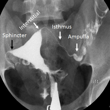 Hysterosalpingography showing normal fallopian tube anatomy with contrast filling and peritoneal spill