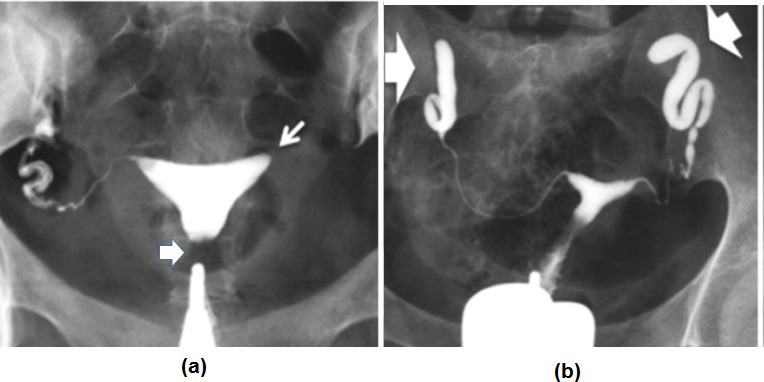 HSG showing tubal occlusion patterns including proximal and distal blockage