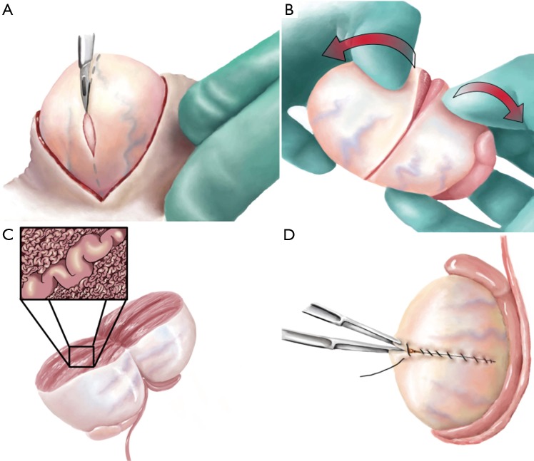 Microsurgical testicular sperm extraction (micro-TESE) technique showing operating microscope view of dilated seminiferous tubules