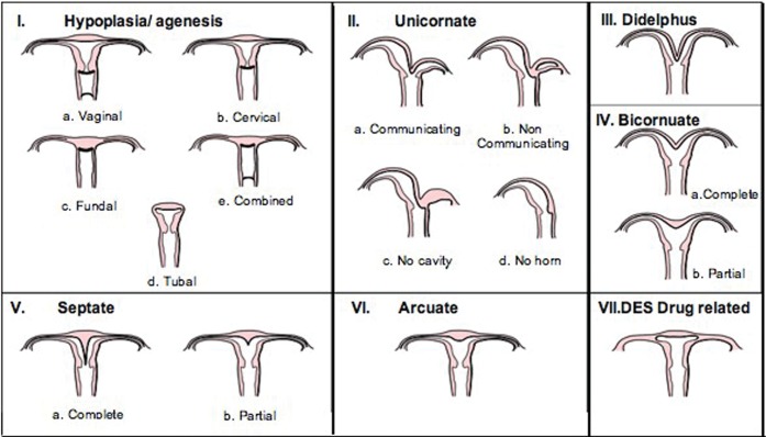 Classification of Mullerian duct anomalies showing types I through VII including agenesis, unicornuate, didelphys, bicornuate, septate, and arcuate uterus