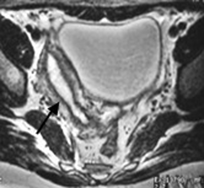 Imaging of bicornuate uterus showing two separate uterine horns with external fundal cleft