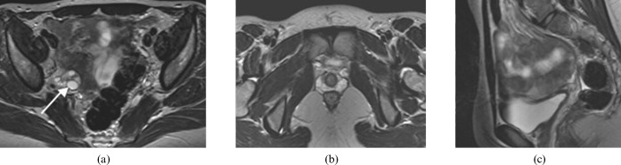 MRI and HSG imaging of septate uterus showing fibrous septum dividing the uterine cavity