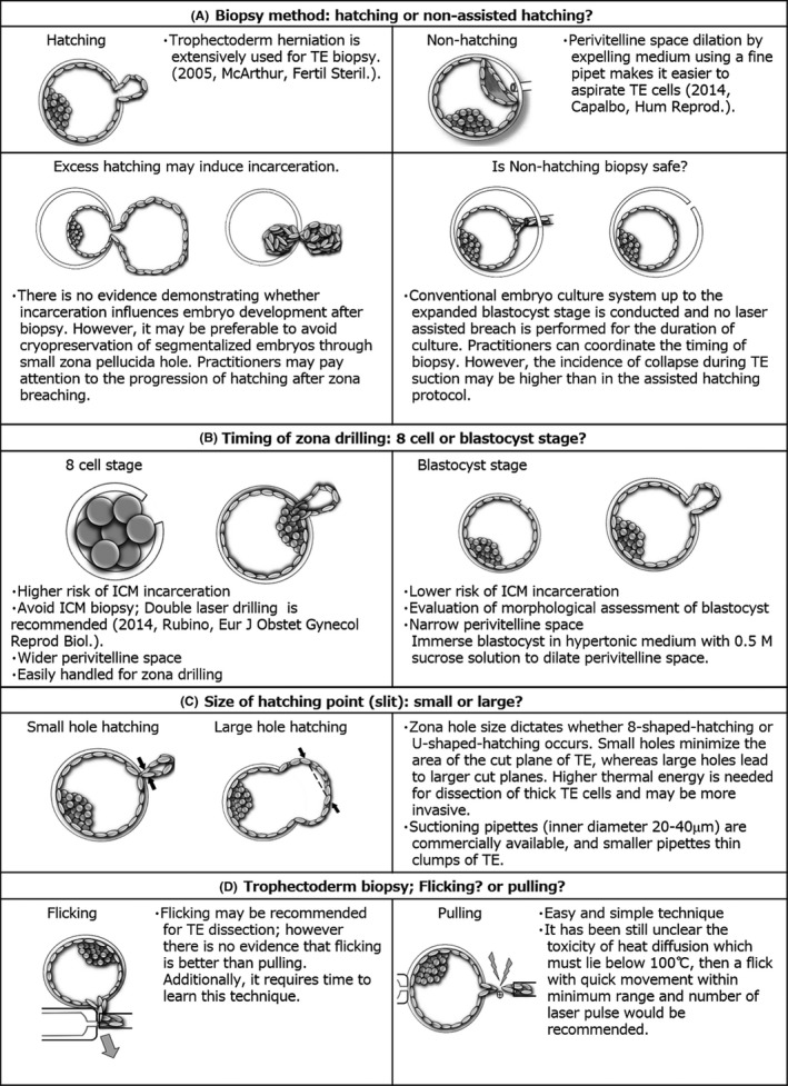 Trophectoderm biopsy procedure for preimplantation genetic testing showing critical steps and laser zona opening