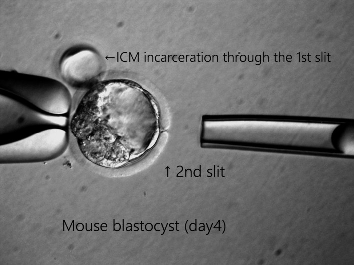 Double zona drilling technique for trophectoderm biopsy showing sequential laser application and cell herniation