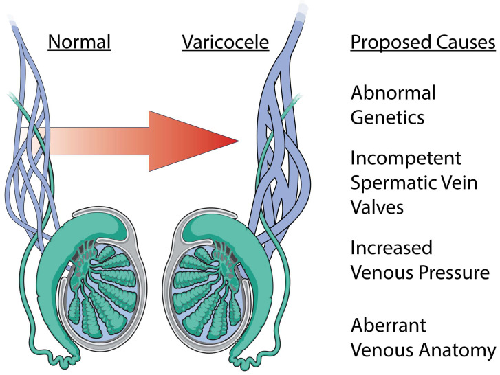 Varicocele etiology and pathophysiology showing venous anatomy, reflux mechanisms, and thermal effects on spermatogenesis