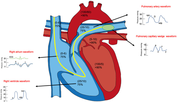 Typical pressure waveforms during right heart catheterization showing RA, RV, PA, and PCWP tracings