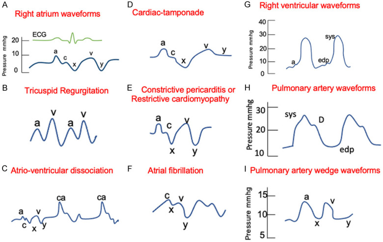 Abnormal hemodynamic waveforms including giant V waves, dip-and-plateau pattern, and equalization of pressures