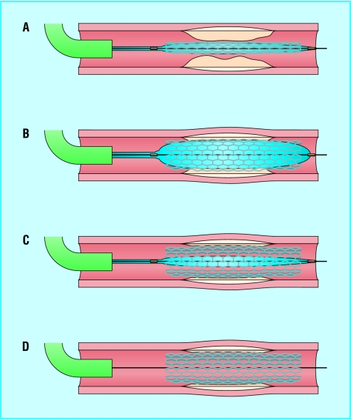 Balloon-mounted coronary stent deployment sequence showing predilation, stent placement, and post-dilation