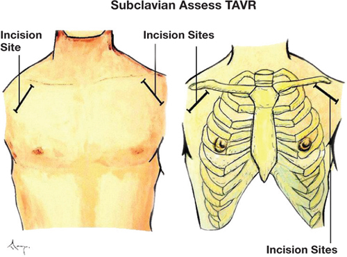 TAVR access routes including transfemoral, transaxillary, transaortic, and transapical approaches