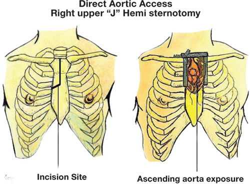 TAVR procedural steps showing valve delivery, positioning at the aortic annulus, and deployment