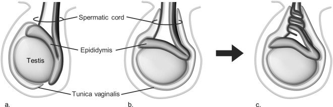 Diagram comparing normal testicular anatomy, bell clapper deformity, and testicular torsion