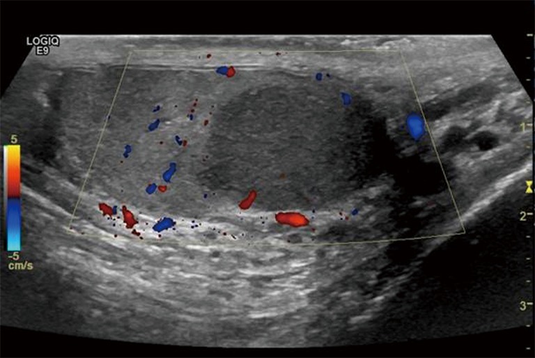 Scrotal ultrasound showing hypoechoic intratesticular mass consistent with seminoma