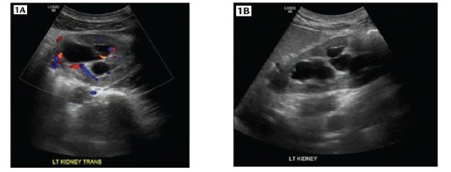 Renal ultrasound showing hydronephrosis secondary to UPJ obstruction