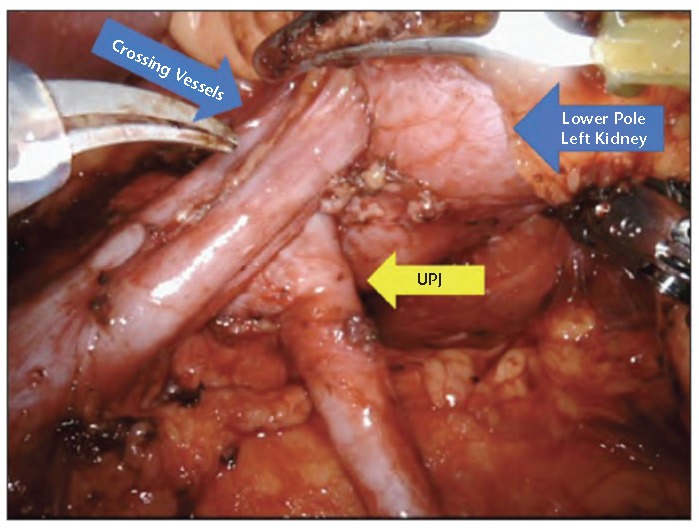 Intraoperative view of UPJ obstruction with anterior crossing vessel during pyeloplasty