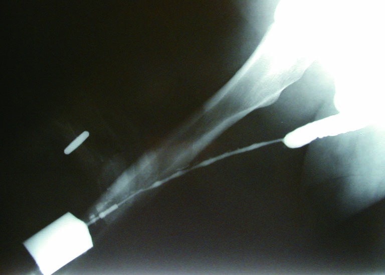 Retrograde urethrogram showing long-segment penile urethral stricture from lichen sclerosus