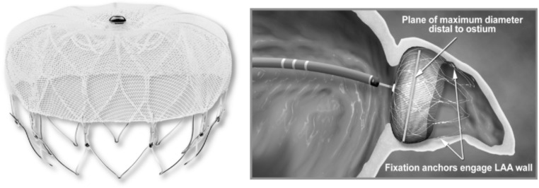 WATCHMAN left atrial appendage closure device showing nitinol frame and polyester fabric cap