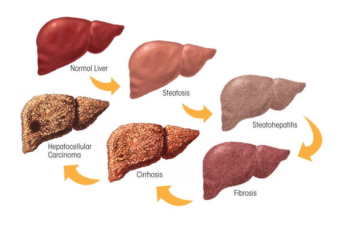 Spectrum of alcoholic liver disease from steatosis to cirrhosis
