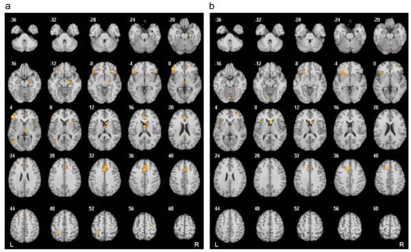 Neuroimaging findings in OCD showing hyperactivation in orbitofrontal cortex and caudate nucleus regions