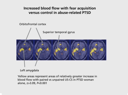 Neural correlates of fear conditioning showing amygdala activation patterns in PTSD compared to controls