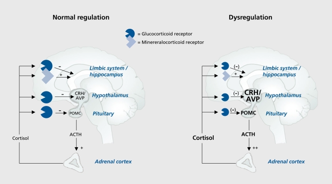 Diagram comparing normal HPA axis regulation with impaired glucocorticoid feedback in depression, showing CRH, ACTH, and cortisol pathways