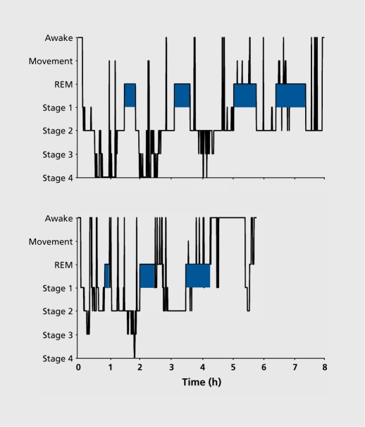 Hypnograms comparing sleep architecture in a healthy individual versus a depressed patient showing shortened REM latency, reduced slow-wave sleep, and fragmented sleep continuity