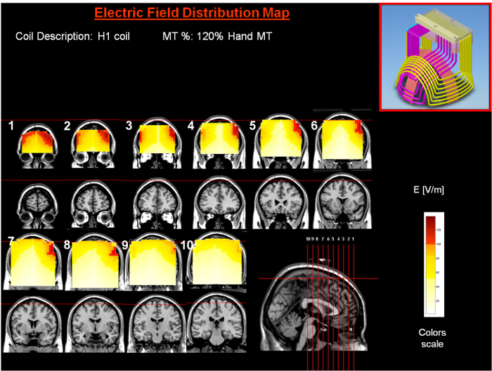 Image showing the electric field distribution during TMS stimulation of the left dorsolateral prefrontal cortex with electromagnetic coil placement