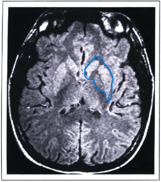 Basal ganglia structural MRI findings in Tourette syndrome showing volume differences in caudate and putamen