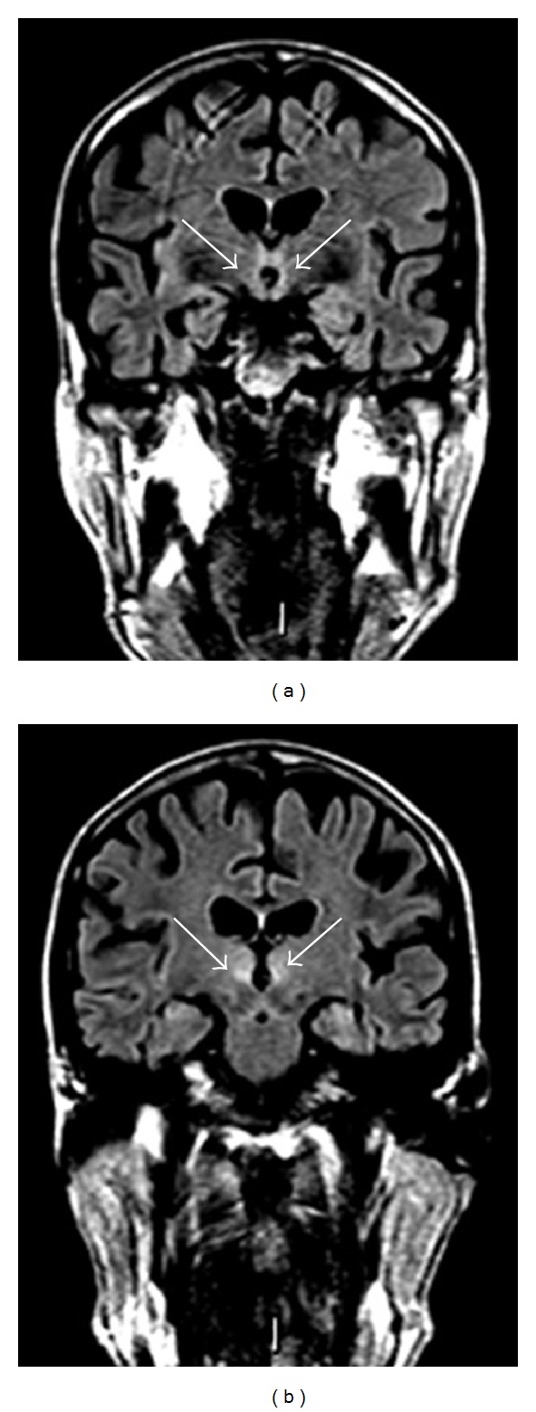 MRI showing mammillary body atrophy in Wernicke encephalopathy