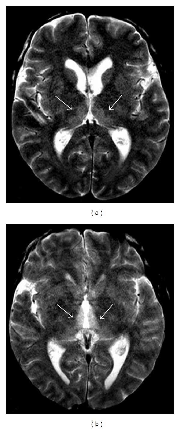 MRI showing thalamic signal abnormality in Wernicke encephalopathy