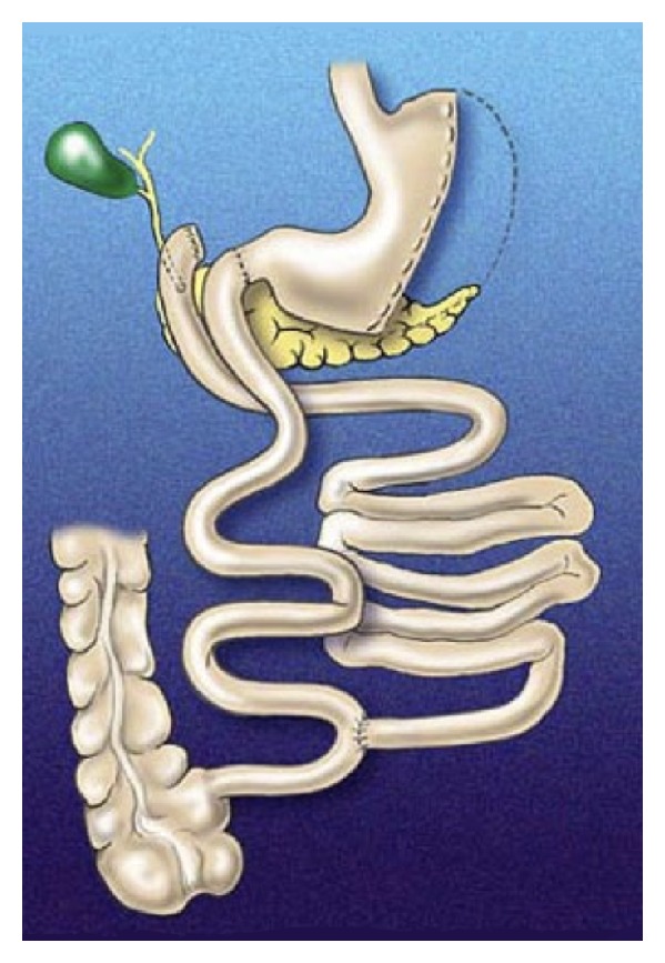 Anatomical diagram of biliopancreatic diversion with duodenal switch showing the sleeve gastrectomy, duodenoileostomy, and short common channel