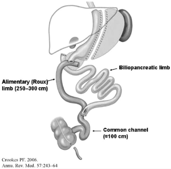 Diagram showing the profound hormonal changes after biliopancreatic diversion with duodenal switch including fat-soluble vitamin malabsorption