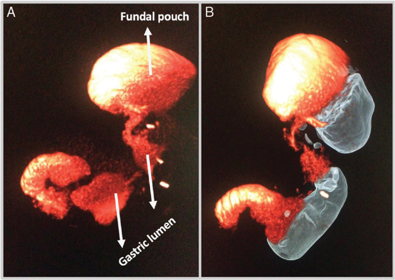 3D rendering showing the reduced gastric volume configuration after endoscopic sleeve gastroplasty compared to native stomach