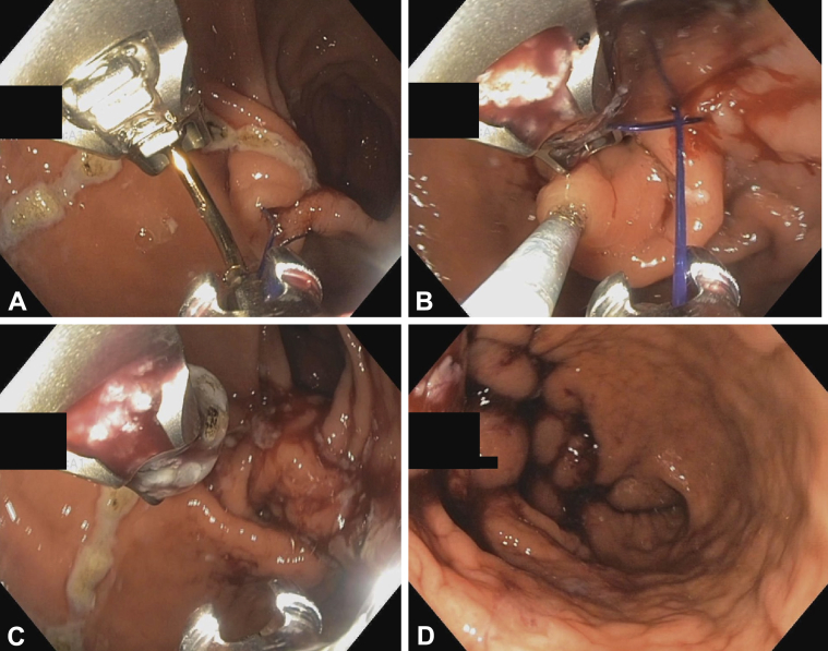 Endoscopic view of endoscopic sleeve gastroplasty suturing technique reducing gastric volume along the greater curvature