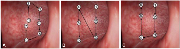 Close-up endoscopic view of ESG suture placement showing tissue approximation and plication