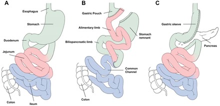 Schematic illustration of preoperative gastric anatomy showing the stomach regions, small bowel segments, and their anatomical relationship relevant to bariatric surgical procedures