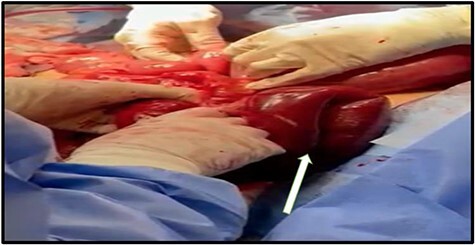Intraoperative photograph showing gangrenous bowel resulting from strangulated internal hernia after bariatric surgery