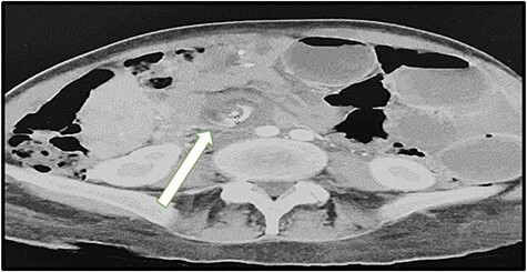 CT scan showing the mesenteric swirl sign indicating internal hernia after Roux-en-Y gastric bypass