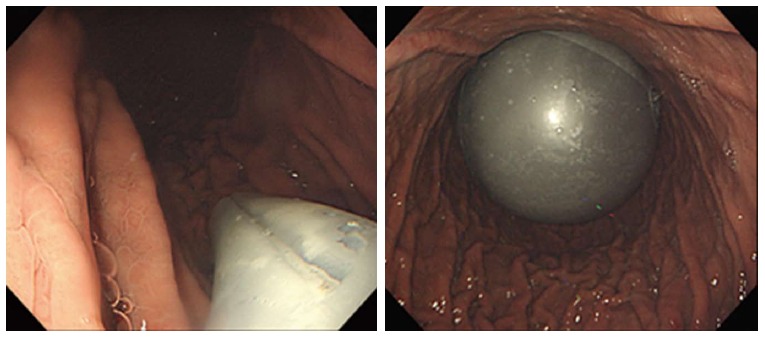 Endoscopic and fluoroscopic images showing intragastric balloon placement within the stomach