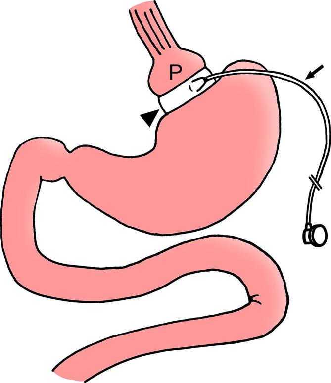 Diagram of laparoscopic adjustable gastric band placement showing the inflatable band around the proximal stomach and the subcutaneous port