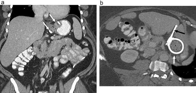 CT scan showing laparoscopic adjustable gastric band in correct position around the proximal stomach