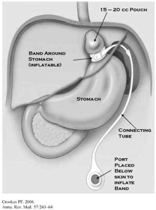Comparison diagram showing the minimal hormonal changes after laparoscopic adjustable gastric banding versus more powerful hormonal effects of other bariatric procedures