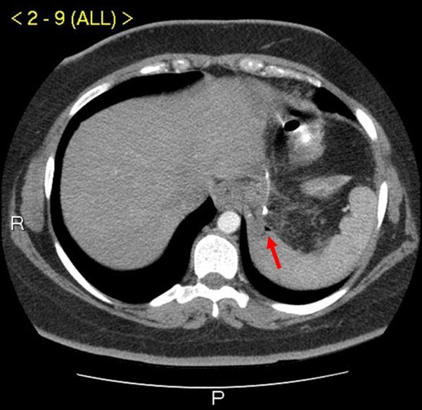 CT scan showing contrast extravasation and extraluminal air indicating anastomotic leak after bariatric surgery